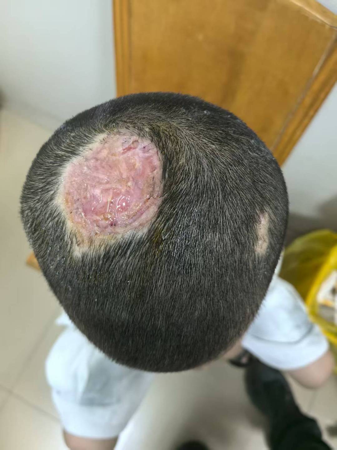 皇冠信用盘APP下载_6岁小男孩领养了只兔子皇冠信用盘APP下载，没想到头上长出脓包，反复溃烂，竟导致永久秃发！